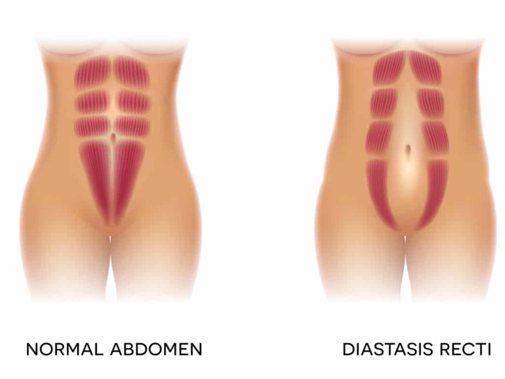 Illustration of diastasis recti