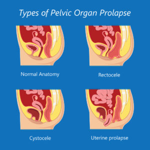 Types of Pelvic Organ Prolapse Chart